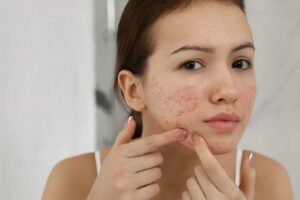 Skin Care Tips: क्या आप रुमाल से मुंहासे को दबाकर फोड़ देते हैं? अगर आप ऐसा करते हैं, तो इन 6 खतरनाक त्वचा समस्याओं के लिए तैयार रहें।