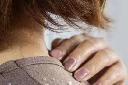 dandruff-in-winter-naturally (1)