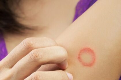 natural-home-remedies-for-ringworm-treatment (1)