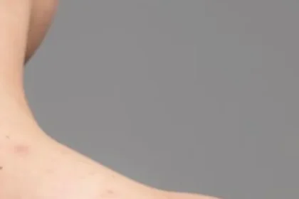 back-acne-3